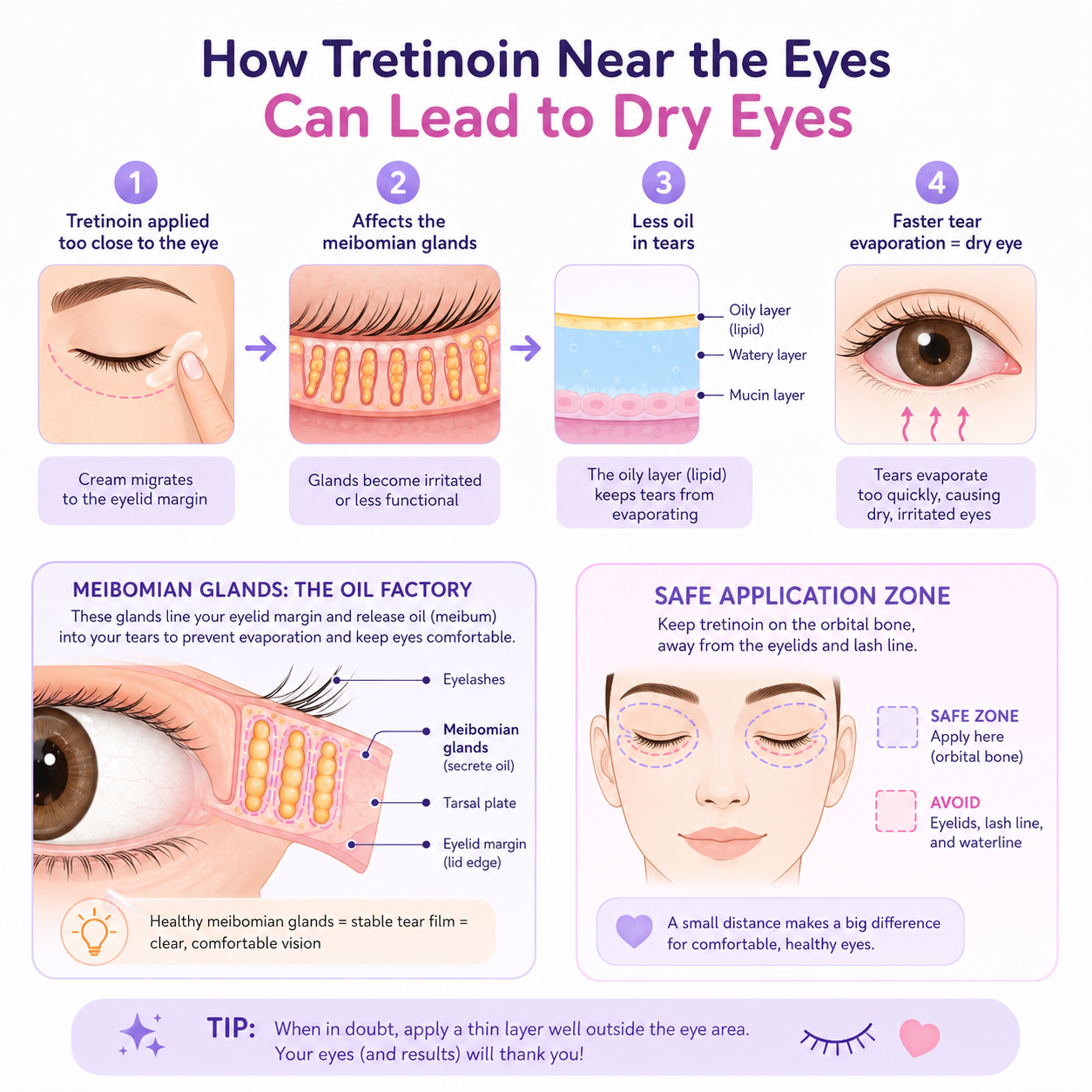 Diagram of how tretinoin near the eye can affect the meibomian glands, reducing the oily layer of the tear film and causing faster tear evaporation